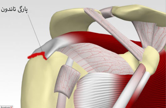 پارگی تاندون شانه