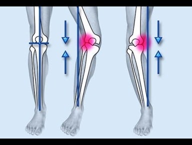 پیشگیری از پاهای پرانتزی